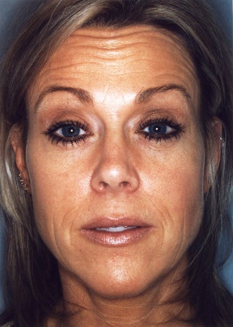 Botox