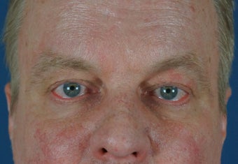 Man in 50's seek non-surgical facial rejuvention
