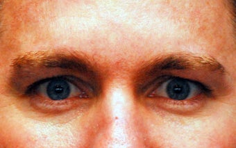 Botox Treatment of the Glabella ( 11s ) 
