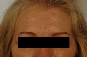 Coreecting Asymmetry with Botox (Dysport Browlift). 