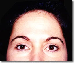 BOTOX 