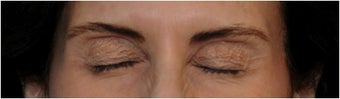 Botox
