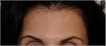 Botox