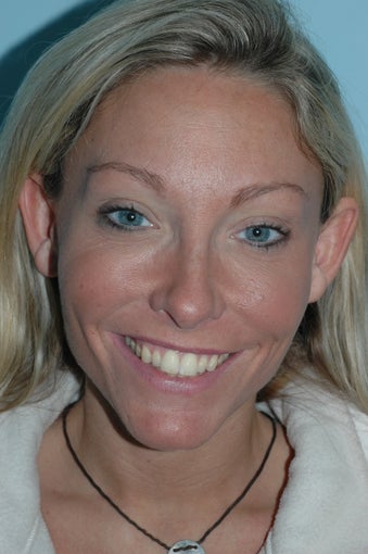 Botox Radiesse