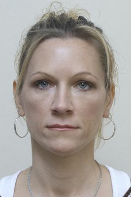 Botox and Restylane