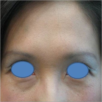 Botox