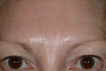 Brow asymmetry