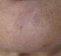 Botox for pebble chin