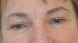 Botox forehead lines (frown lines) 