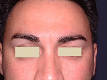 Botox