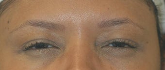 Botox Treatment
