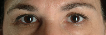 Botox