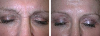 Botox