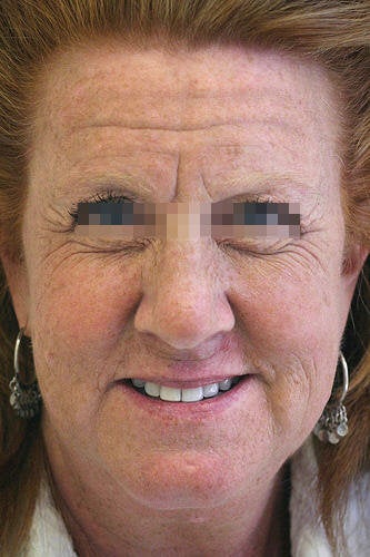 Botox for Forehead, Glabella and Crows Feet