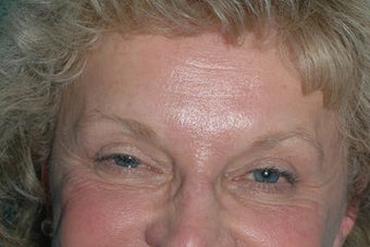 Crowsfeet treated with Botox Cosmetic