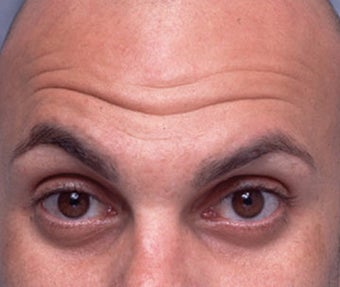 Cosmetic Microdroplet BOTOX® Treatment