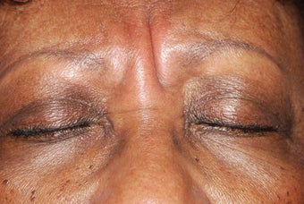 Botox for frown lines