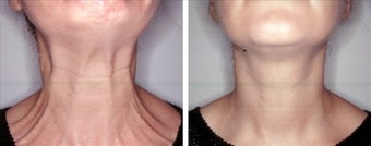 Botox for platysmaplasty 