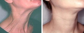 Botox for platysmaplasty