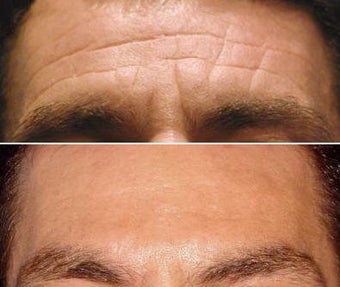 Botox for Men