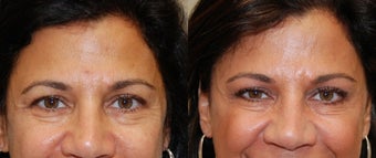 BOTOX Cosmetic: 3 areas
