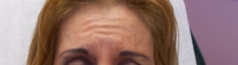Botox