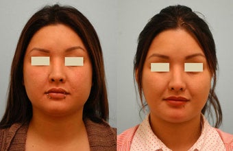 Botox Jaw Reduction