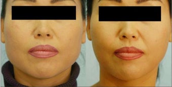 Botox Jaw Reduction