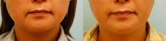 Botox Jaw Reduction