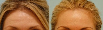 Botox