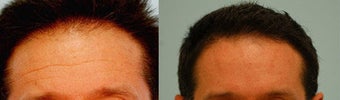 Botox