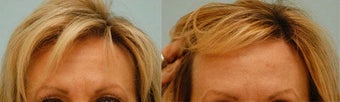 Botox
