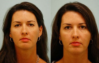 Botox