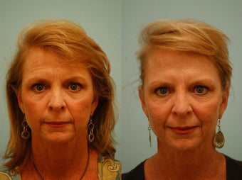 Botox