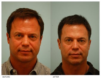 Botox
