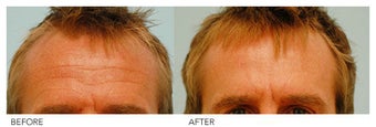 Botox