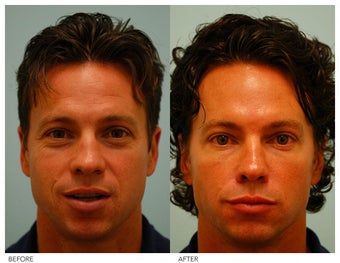 Botox, Fillers