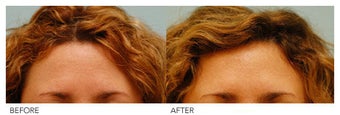 Botox