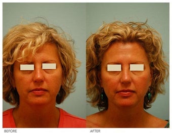 Botox