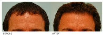 Botox