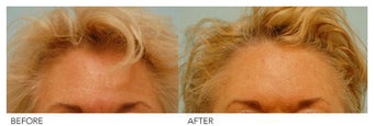 Botox