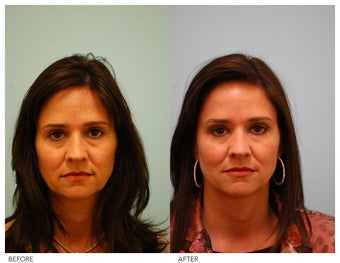 Botox, Fillers