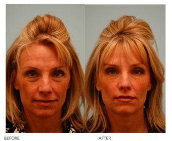 Botox