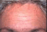 Botox
