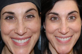 Botox Cosmetic to treat Crow's Feet