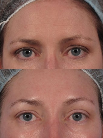 Botox to glabella and "crow's lines"