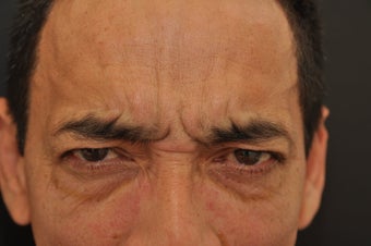 Botox to forehead and glabella