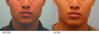 Botox Jaw Reduction