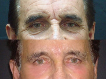 Botox
