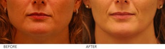 Botox Jaw Reduction